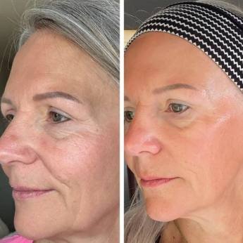 GuaPure™ Sculpter Linfatico